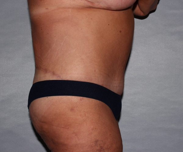 after lower body lift female patient - right angle case 7516
