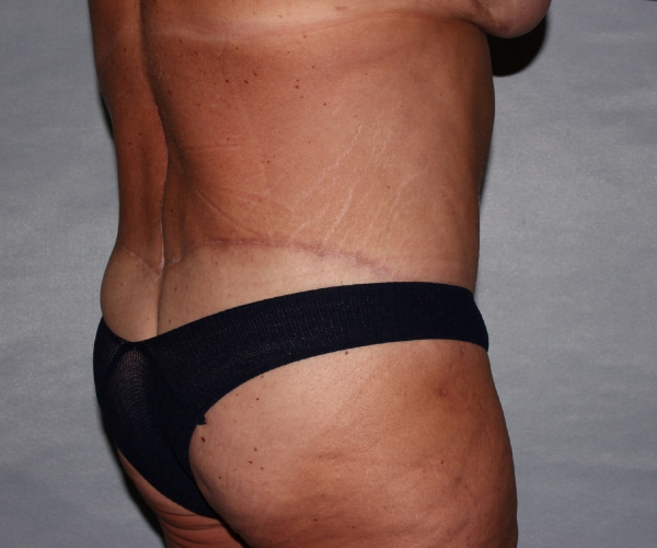 after lower body lift female patient - hip view right angle case 7516