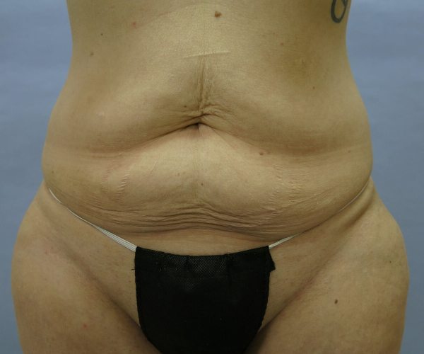 before lower body lift female patient - front view case 7545