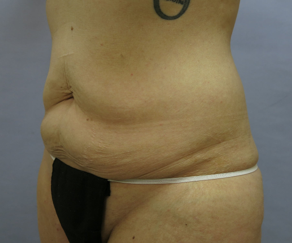 before lower body lift female patient - 45 degrees left 45 degree angle case 7545