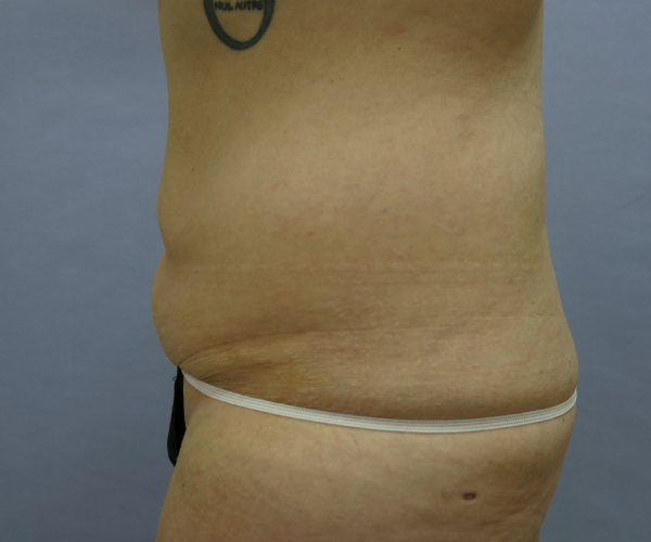 before lower body lift female patient - left angle case 7545