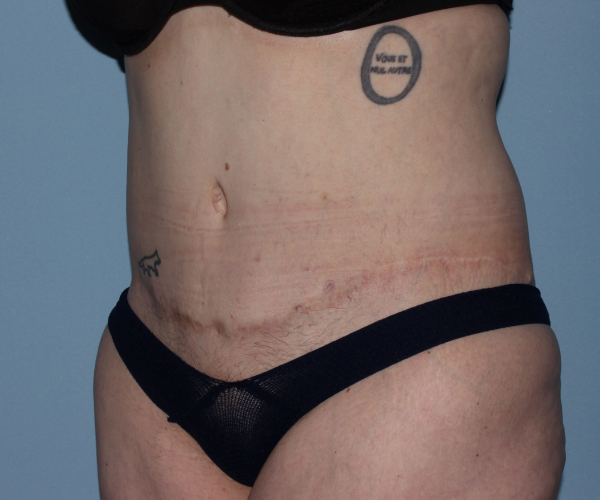 after lower body lift female patient - 45 degrees left angle case 7545