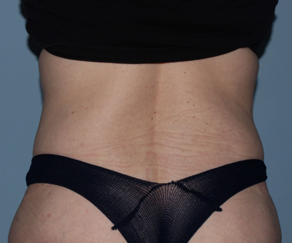 after lower body lift female patient - back view case 7545