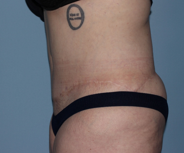 after lower body lift female patient - left side view case 7545