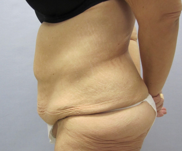 before lower body lift female patient left angle case 7564