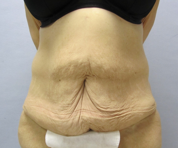before lower body lift female patient front view case 7564