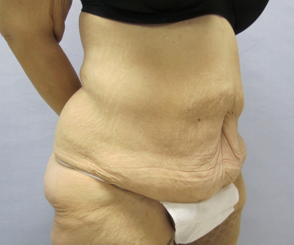 before lower body lift female patient right angle case 7564