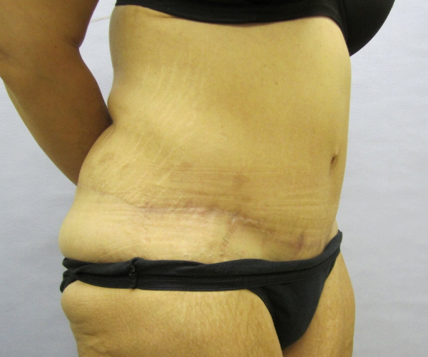 after lower body lift female patient right angle case 7564