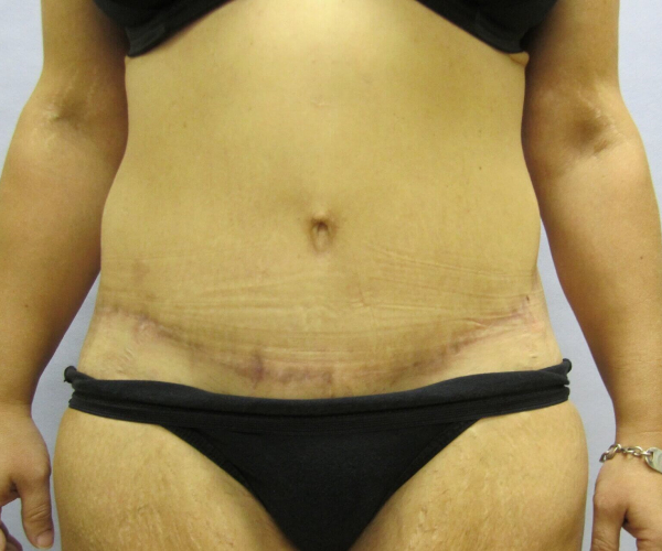 after lower body lift female patient front view case 7564