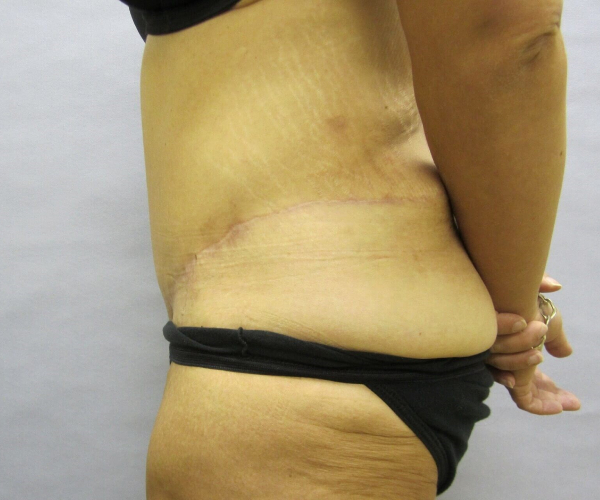 after lower body lift female patient left angle case 7564
