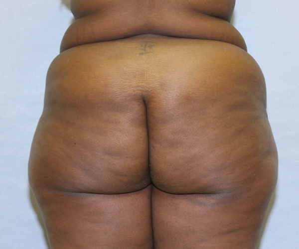 before lower body lift female patient - back view case 7576