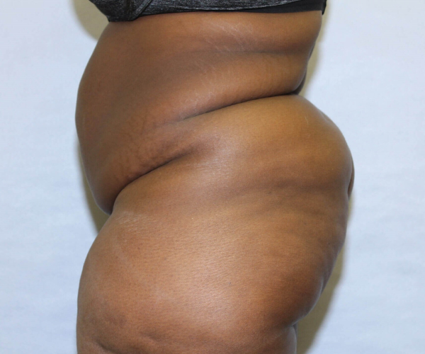 before lower body lift female patient - left side view case 7576