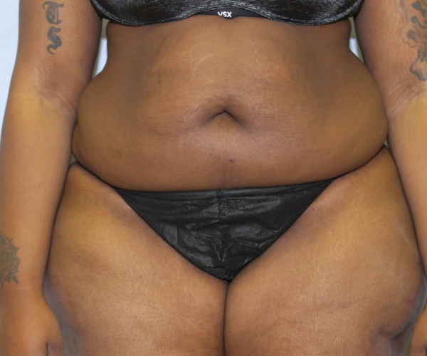 before lower body lift female patient - front view case 7576