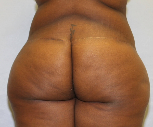 after lower body lift female patient - back view case 7576