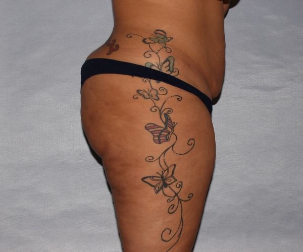 before lower body lift female patient right side view case 7586