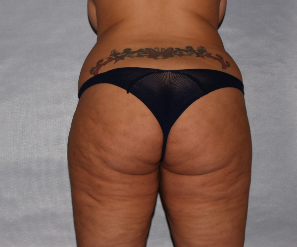 before lower body lift female patient back view case 7586