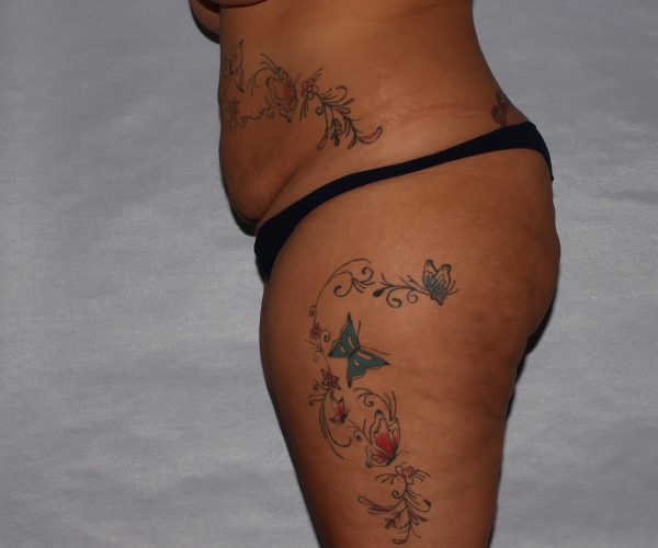 before lower body lift female patient left side case 7586