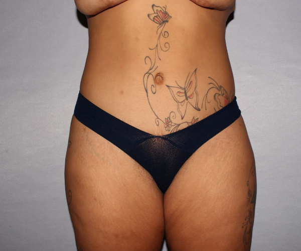 after lower body lift female patient front view case 7586