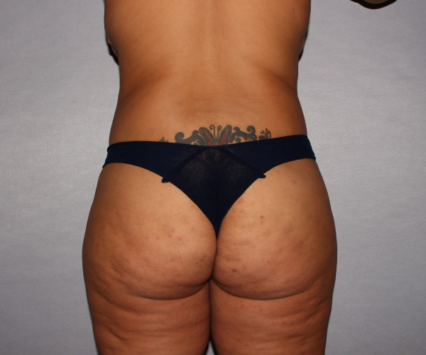 after lower body lift female patient back view case 7586