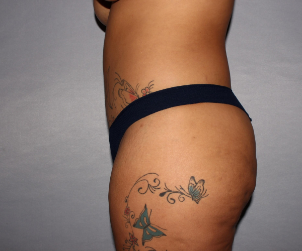 after lower body lift female patient left angle case 7586