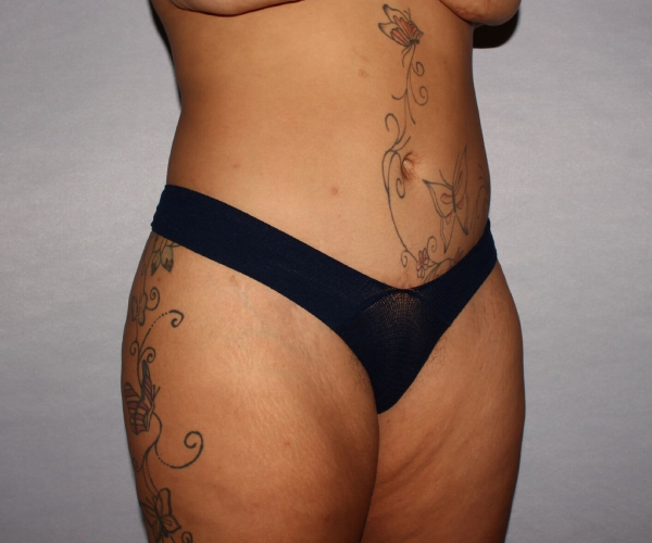 after lower body lift female patient right angle case 7586