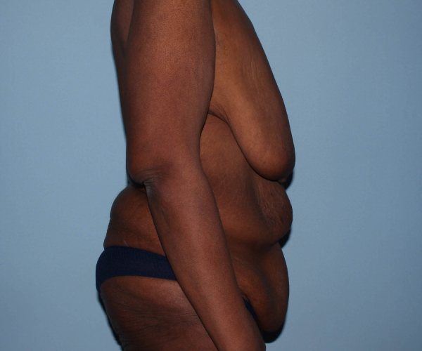 before lower body lift female patient - right angle case 7602