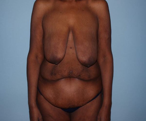 before lower body lift female patient hands on side - front view case 7602