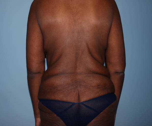 before lower body lift female patient hands on lap - back view case 7602