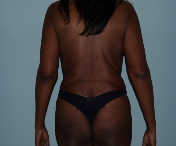 after lower body lift female patient hands on side -back view case 7602