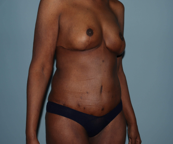 after lower body lift female patient - 45 degrees right angle case 7602