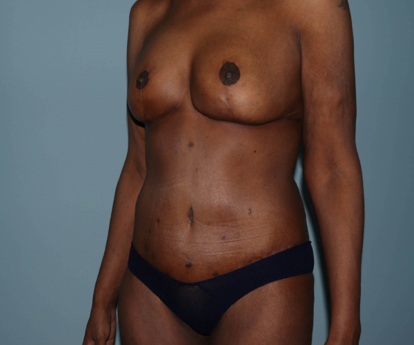 after lower body lift female patient hands on side - 45 degrees left angle case 7602