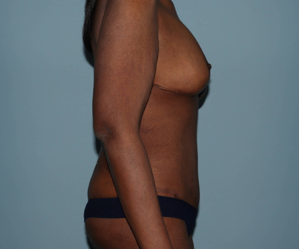 after lower body lift female patient hands on side - right angle case 7602