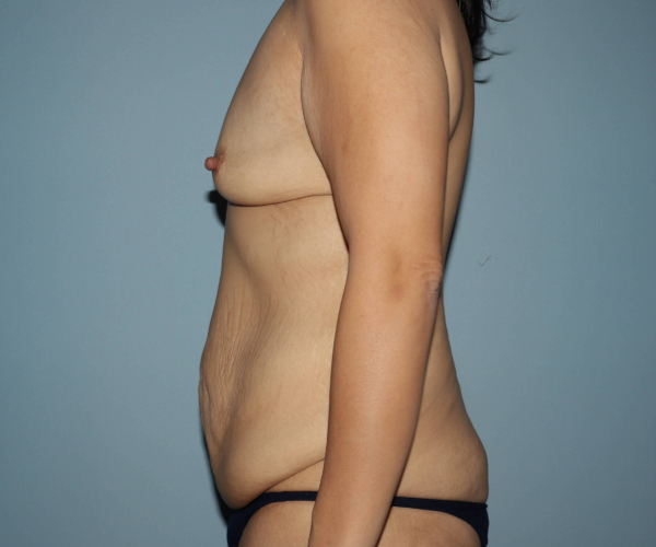 before lower body lift female patient - left angle case 7618