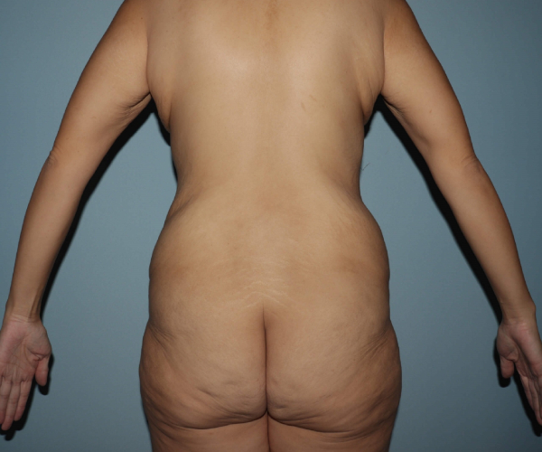 before lower body lift female patient - back view case 7618