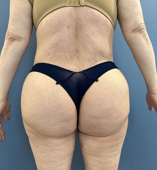 After Image of Lower Body Lift, Buttock Lift or Gluteal Lift Back Side view P-7634