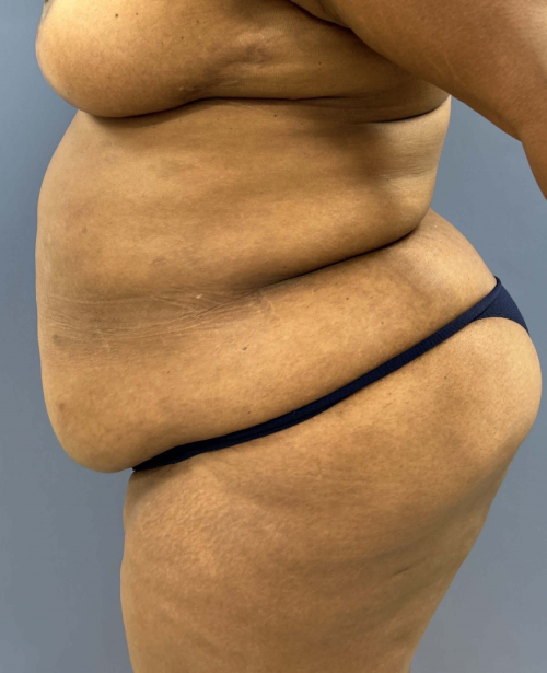 Before Image of Lower Body Lift Shaping the Buttock Left Side View P-7638