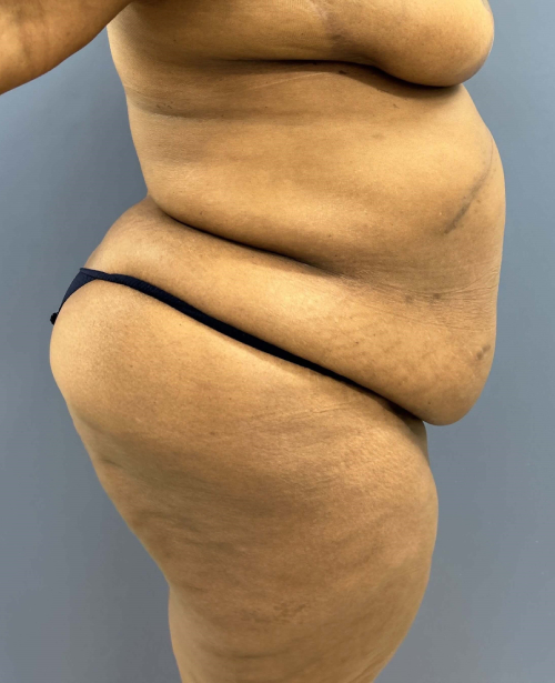 Before Image of Lower Body Lift Shaping the Buttock Right Side View P-7638