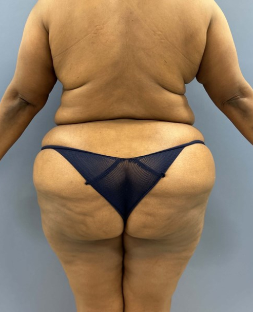 After Image of Lower Body Lift Shaping the Buttock Back Side View P-7638
