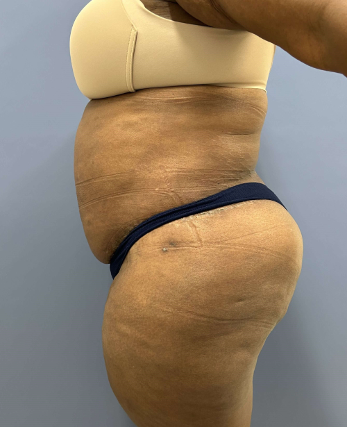 After Image of Lower Body Lift Shaping the Buttock Right Side View P-7638