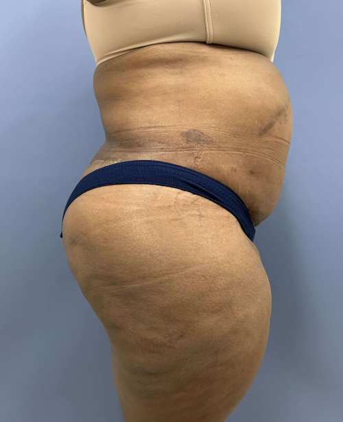 After Image of Lower Body Lift Shaping the Buttock Right Side View P-7638
