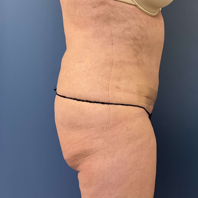 Before Image of Lower Body Lift, Buttock Lift or Gluteal Lift Right Side view P-7634