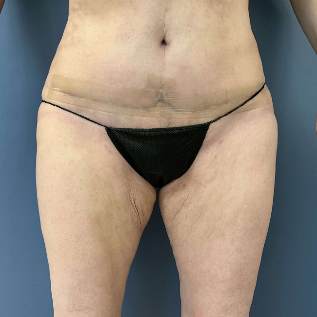 Before Image of Lower Body Lift, Buttock Lift or Gluteal Lift Front Side view P-7634