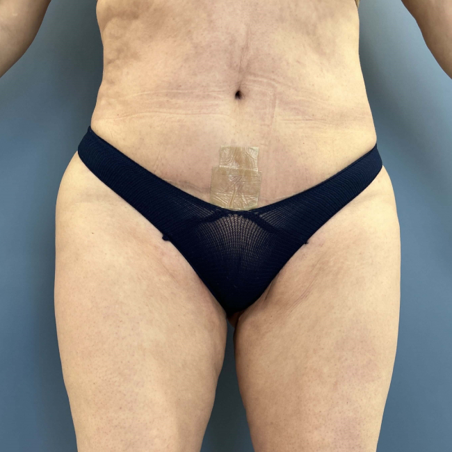 After Image of Lower Body Lift, Buttock Lift or Gluteal Lift Front Side view P-7634