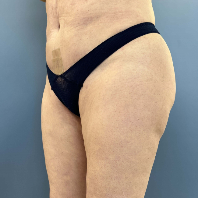 After Image of Lower Body Lift, Buttock Lift or Gluteal Lift Left Side 45 degree view P-7634