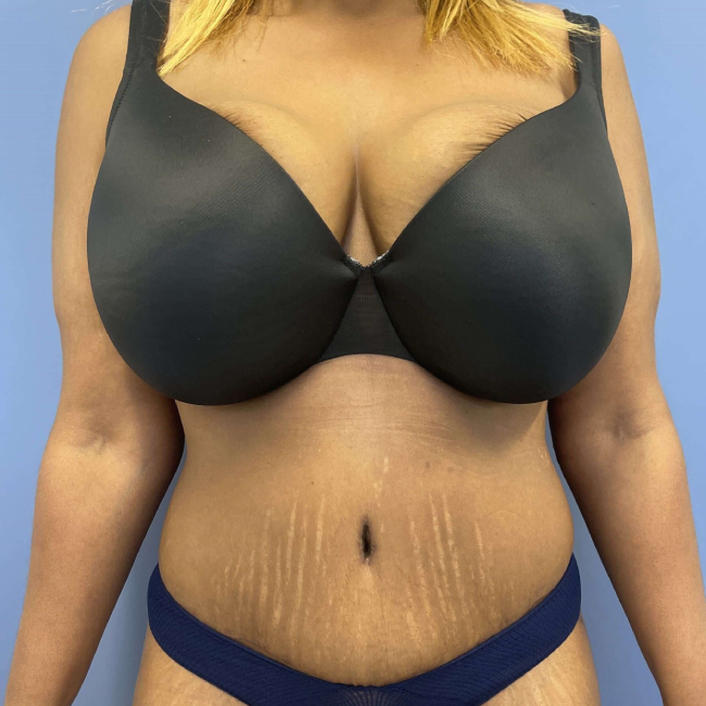 After image of Lower Body Lift with Liposuction Front Side View P-7637