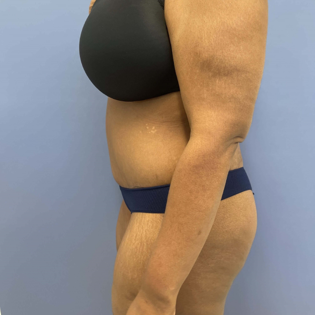 After image of Lower Body Lift with Liposuction Left Side View P-7637