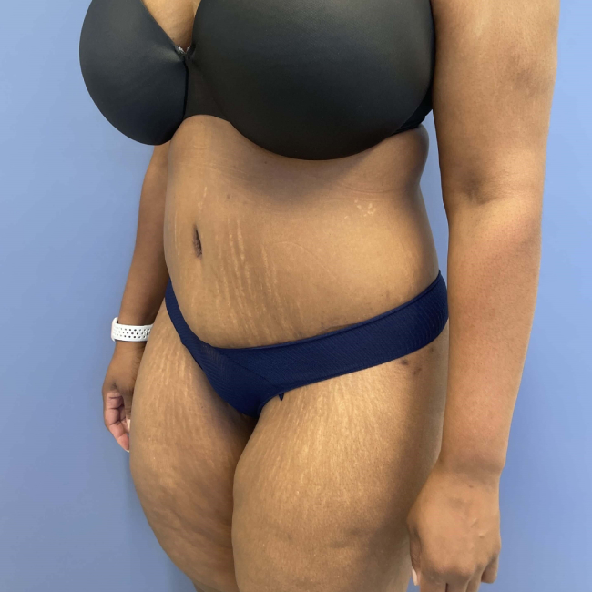 After image of Lower Body Lift with Liposuction Left Side 45 degree View P-7637