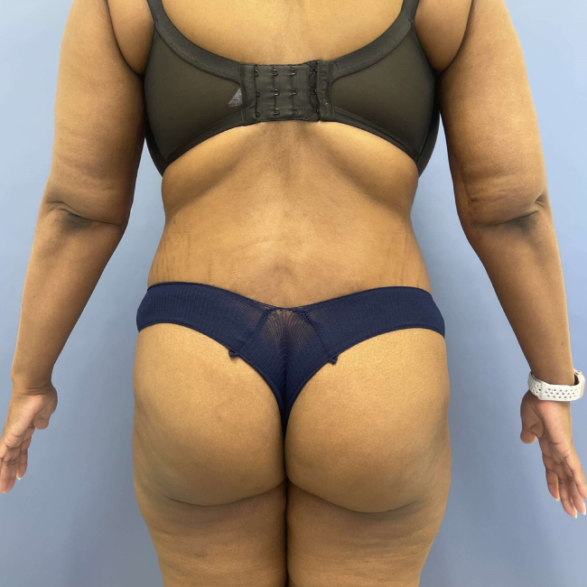 After image of Lower Body Lift with Liposuction Back Side View P-7637