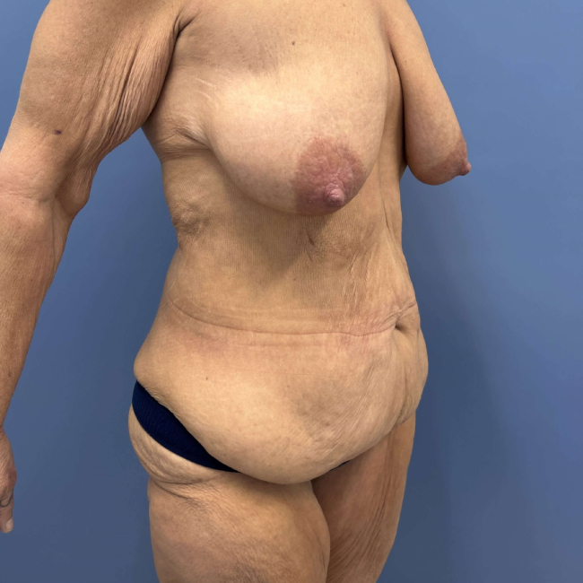 Before Image of Lower Body Lift After Bariatric Body Contouring Right Side 45 degree View P-7633
