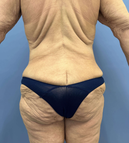 Before Image of Lower Body Lift After Bariatric Body Contouring Back Side View P-7633